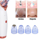 Removedor Cravos e Espinhas Extrator de Cravos Sucção a Vácuo Aparelho Recarregável Sugador Remove Acne